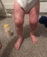Eczema on baby's legs
