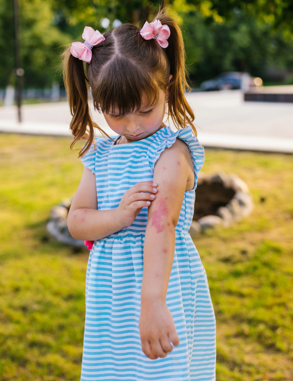 Girl scratching inflamed eczema
