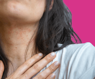 Image of young girl with her Eczema creams